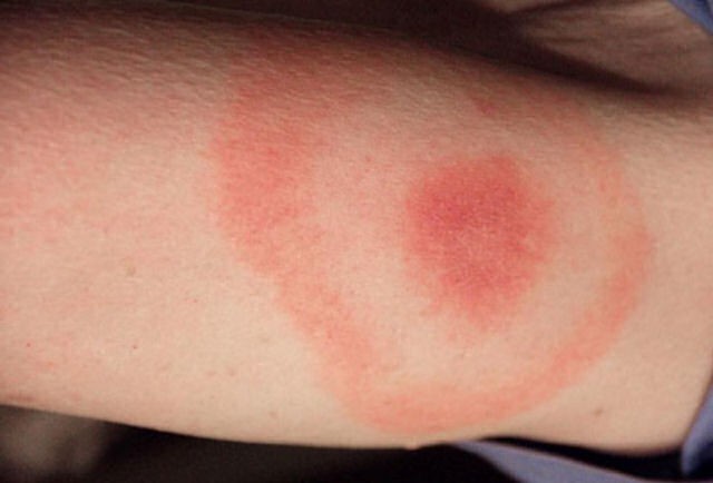 bullseye rash